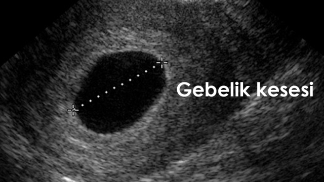 What Is An Empty Pregnancy, Why Does It Happen? What Are The Symptoms Of An Empty Pregnancy, What Is It Determined In The Week?